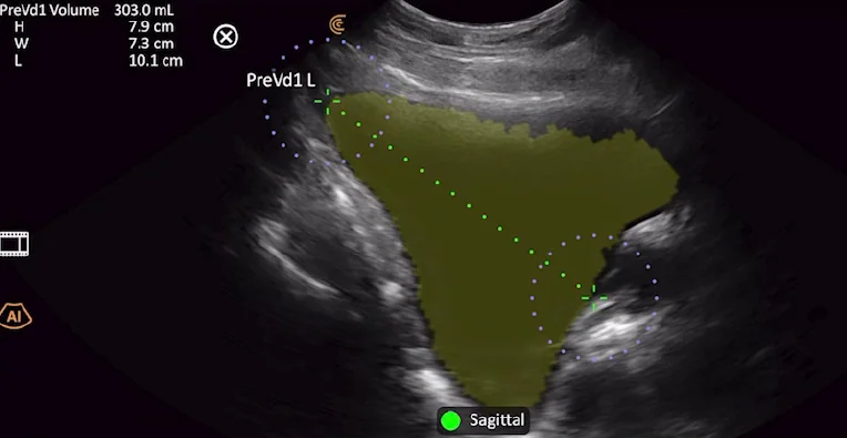 Bladder AI