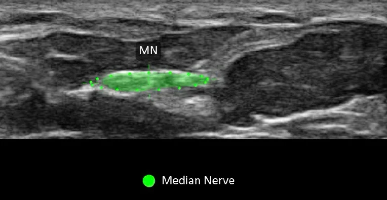 Median Nerve AI